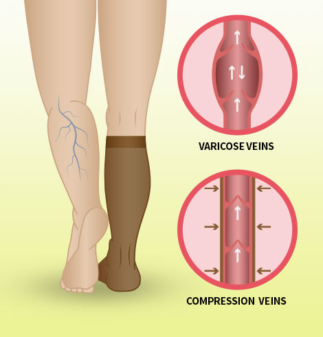 Why do nurses wear compression socks? – zszbace brand store