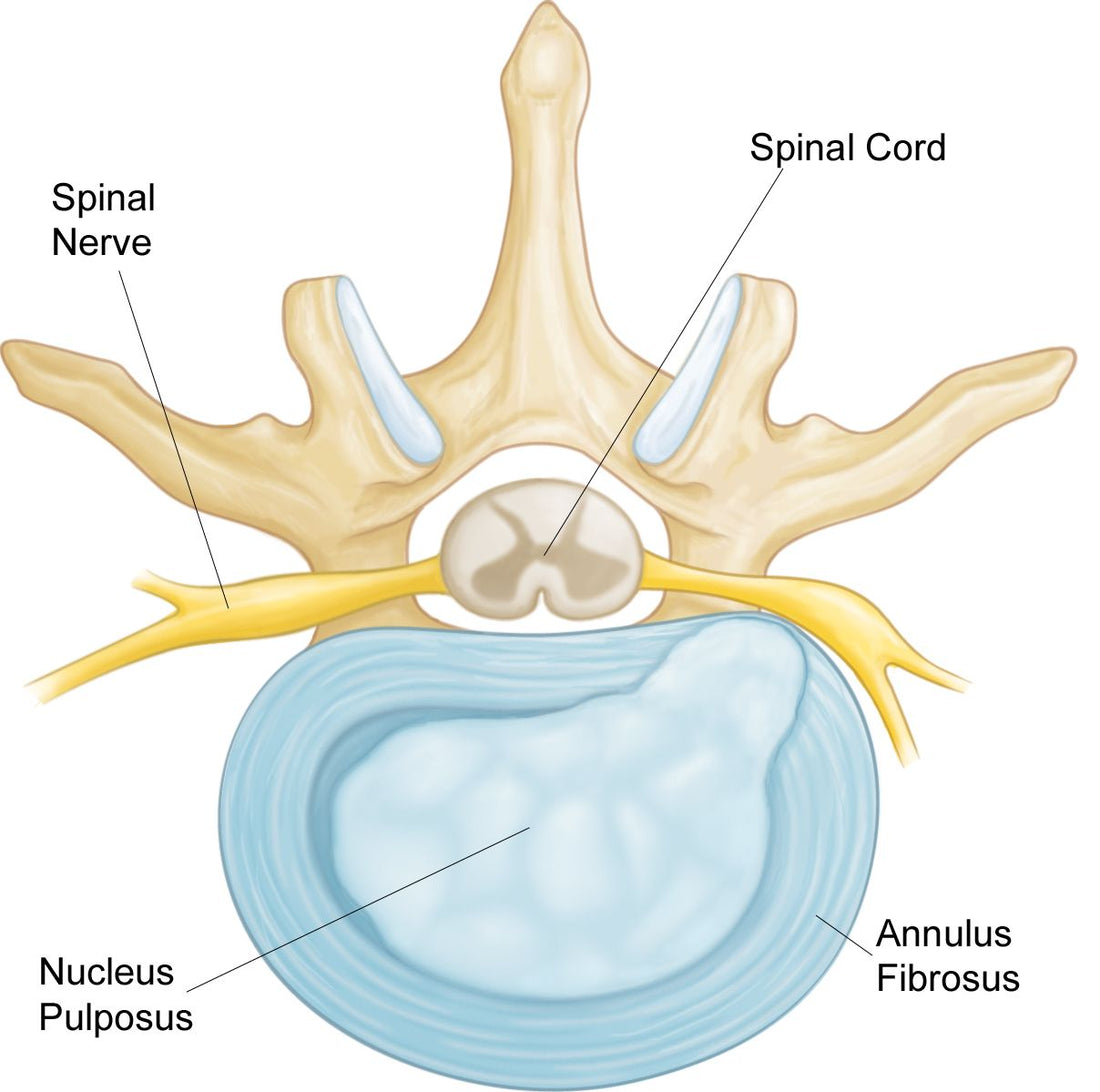 Low Back Pain : Causes, symptoms, and treatments