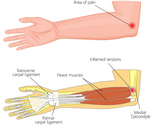 Do you have elbow pain when lifting weights?