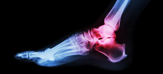 Ankle fracture diagnosis, treatment, surgery and rehabilitation