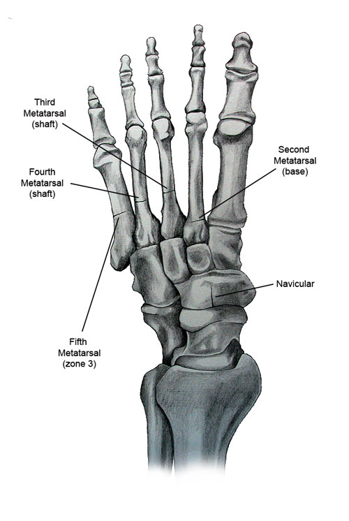 Ankle Stress Fracture