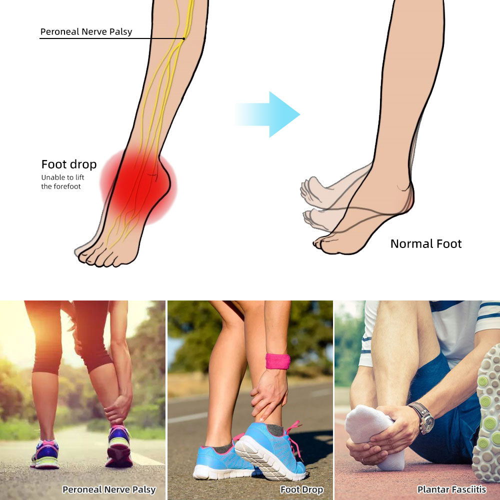 Drop Foot Brace Orthosis ​Foot Drop Orthosis ​for Foot Drop Achilles Tendon  Injury Stroke Peroneal Nerve Injury Spinal Cord Injury Hemiplegia Relieve